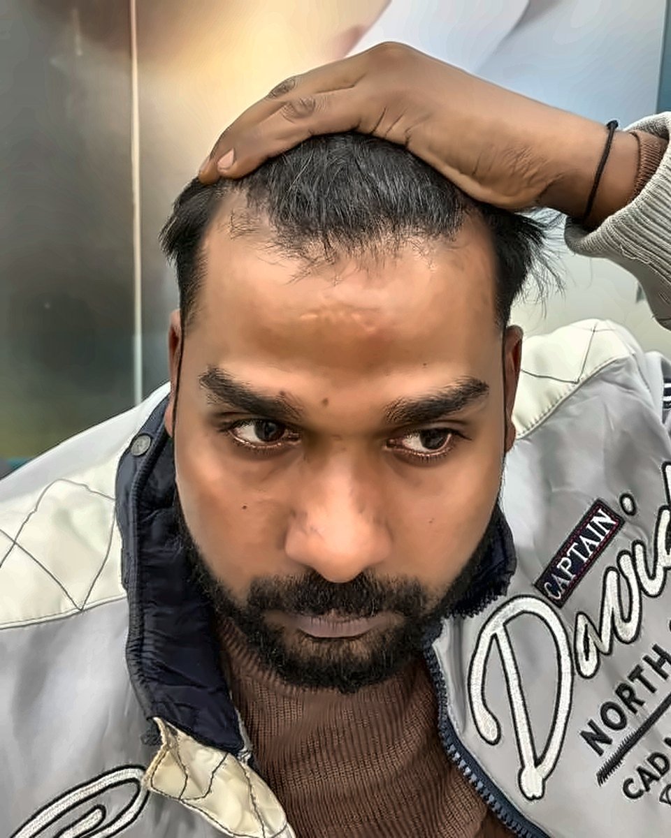 Before treatment – Hairline & frontal restoration