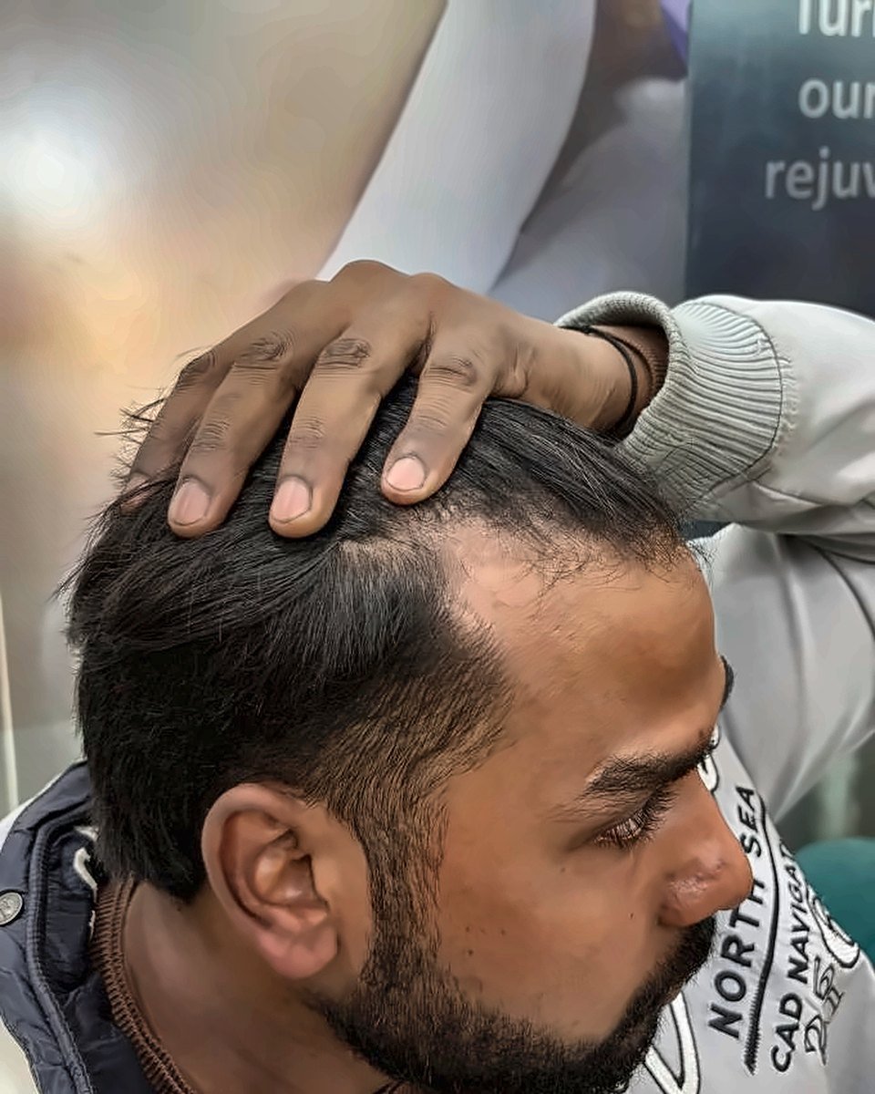 Before treatment – Temple & side restoration