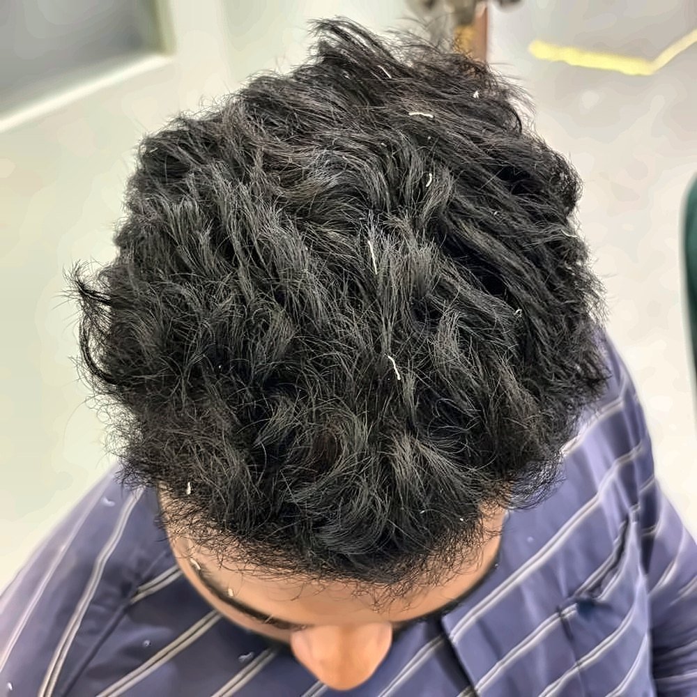 After treatment – Frontal & mid-scalp density