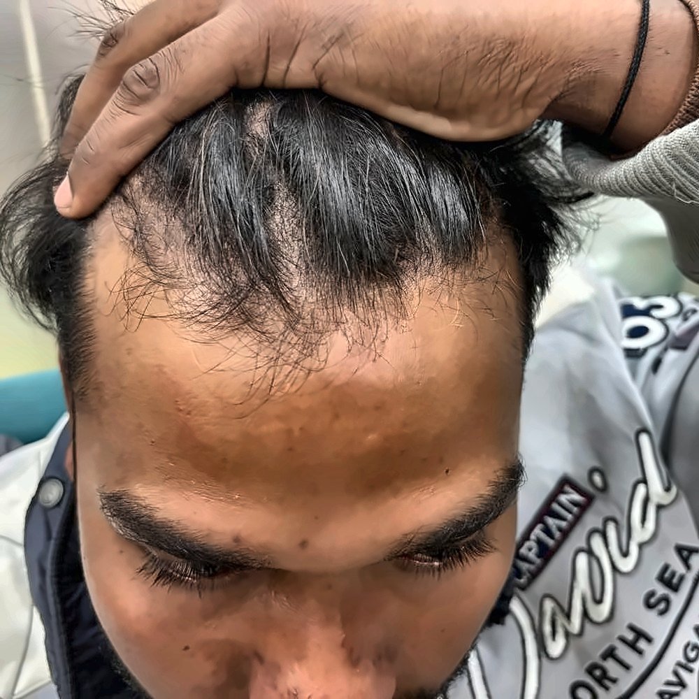 Before treatment – Frontal & mid-scalp density