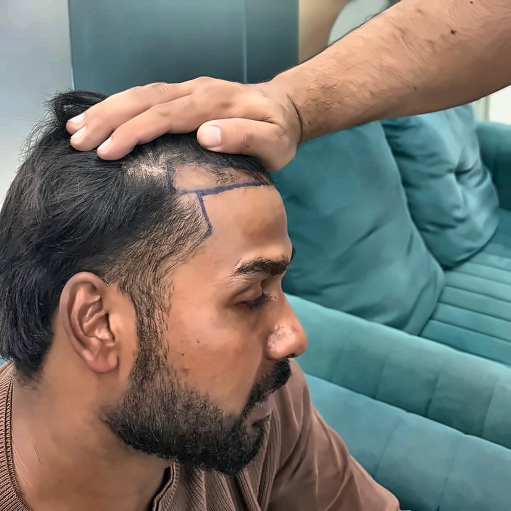 DHI Hair Transplant at SOZO Ghaziabad