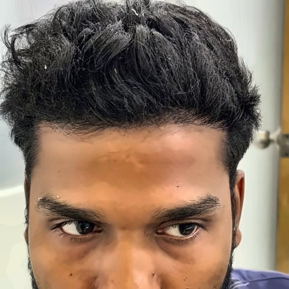 Eyebrow Transplant at SOZO Ghaziabad