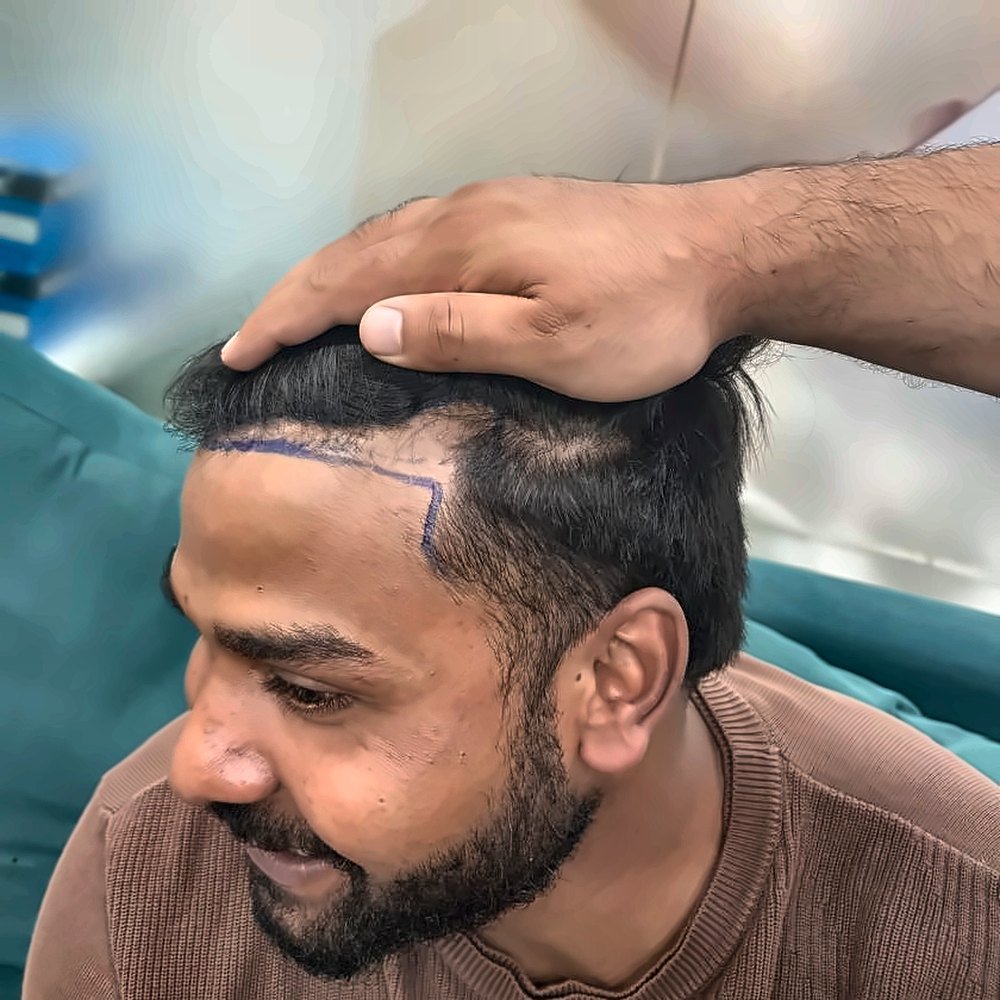 FUE Hair Transplant at SOZO Ghaziabad