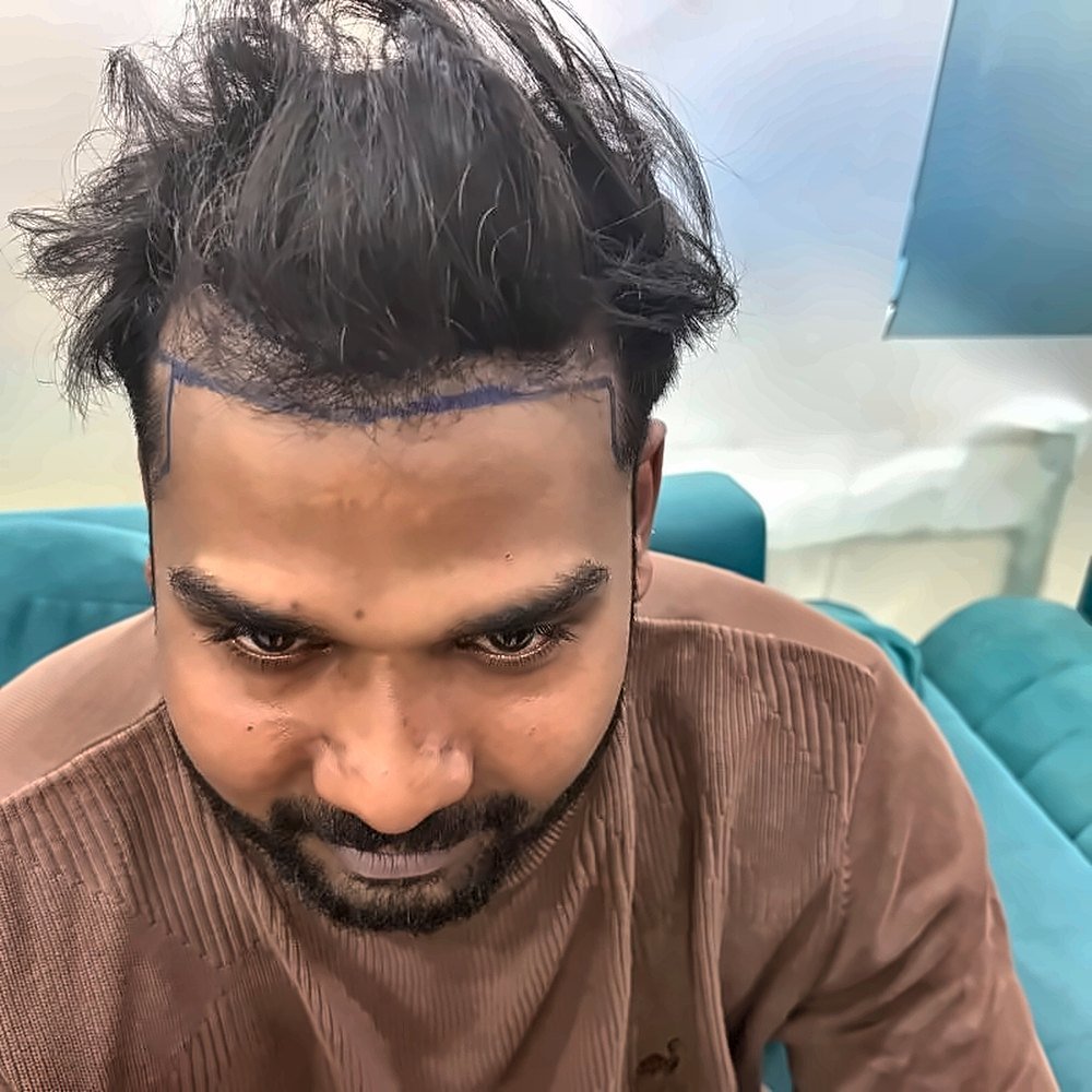Hair Transplant at SOZO Ghaziabad