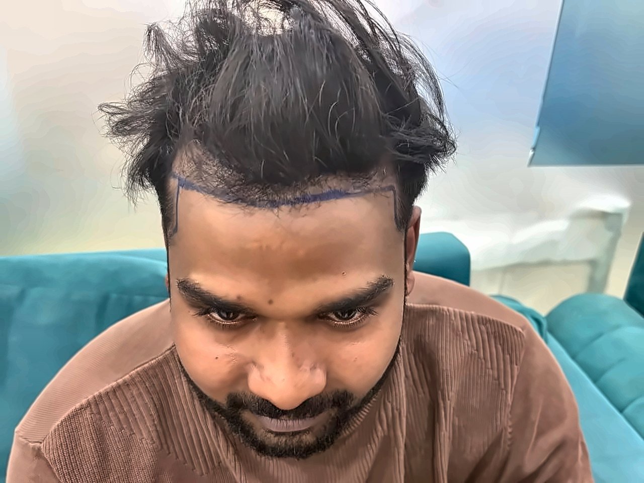 Hairline design – SOZO patient
