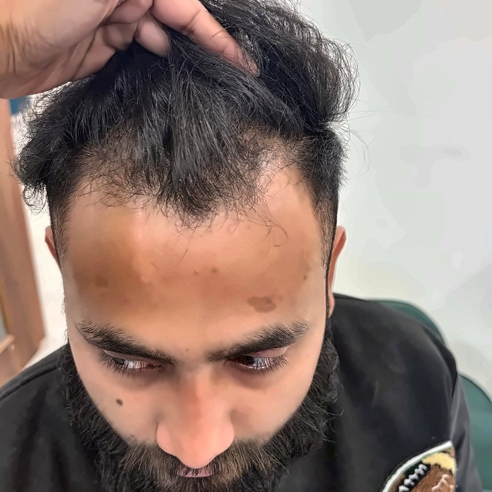 Hair Mesotherapy at SOZO Ghaziabad