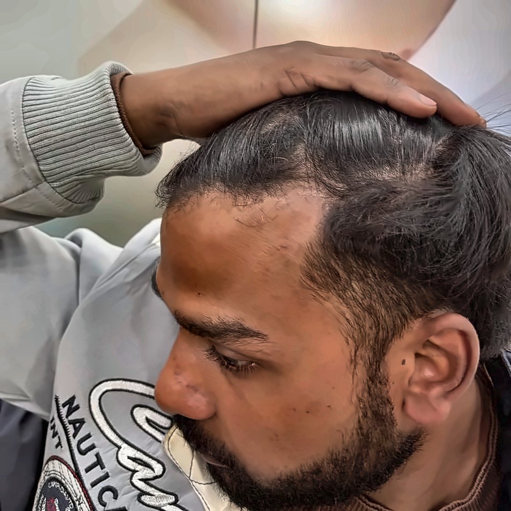 PRP Hair Treatment at SOZO Ghaziabad