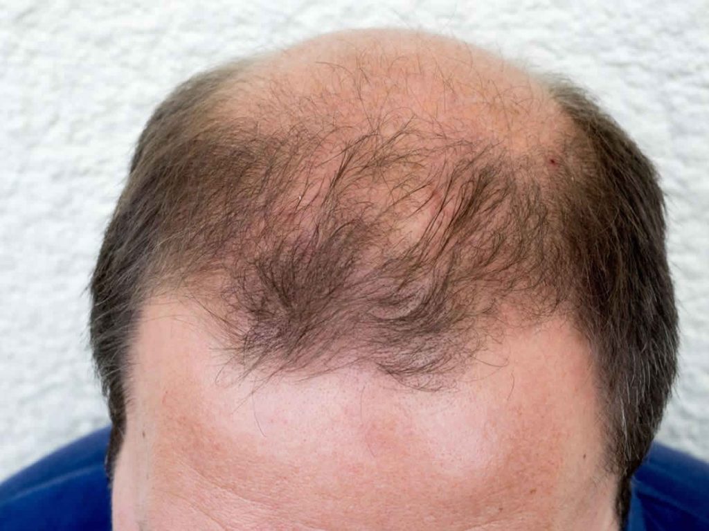 Best Hair Transplant Clinic in Ghaziabad