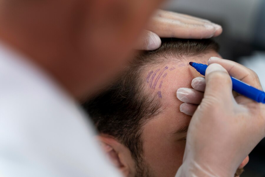 Best Hair Transplant in Ghaziabad