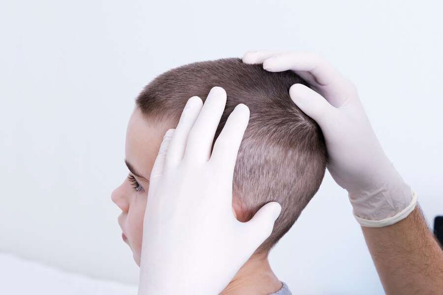 Best Hair Transplant in RDC Raj Nagar, Ghaziabad