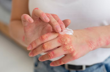 best treatment of psoriasis in Raj Nagar Extension
