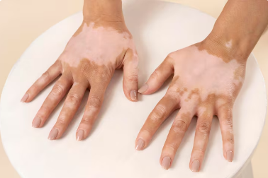 Best Vitiligo Treatment in Raj Nagar Extension