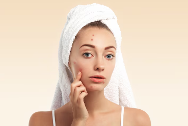 Best Acne and pimples Homeopathy Treatment in Ashok Marg