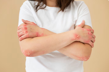 Best Atopic dermatitis Homeopathy Treatment in Ashok Marg