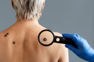 Best Warts Treatment in Ghaziabad